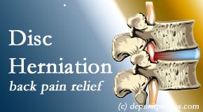 Pensacola Spinal Rehab Center uses non-surgical treatment for relief of disc herniation related back pain. 