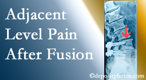 Pensacola Spinal Rehab Center offers relieving care non-surgically to back pain patients experiencing adjacent level pain after spinal fusion surgery.
