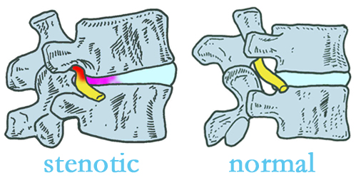 Pensacola stenotic and normal spinal discs